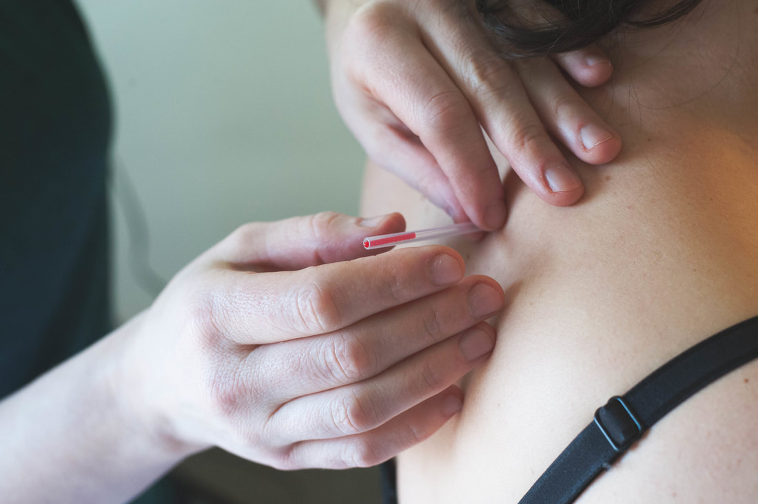 Image shows acupuncturist inserting needle on the upper back